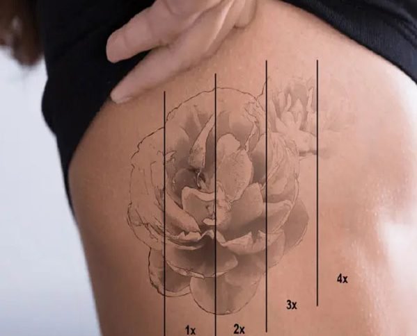 Laser Tattoo Removal treatment dermatologists in Modesto laser tattoo  removal