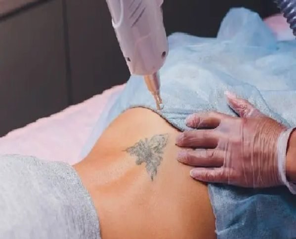 Traumatic Tattoo Removal | McLean & Woodbridge Virginia | Skin & Laser  Dermatology Center