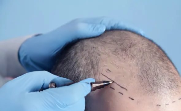 22-Year-Old Hair Transplant Results: A Young Adult’s Transformation