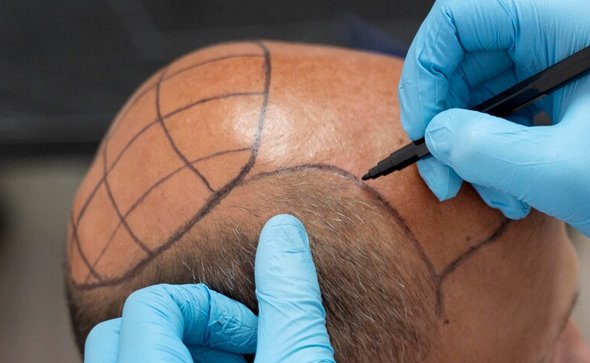 1000 Graft Hair Transplant: Detailed Look at Smaller Procedures