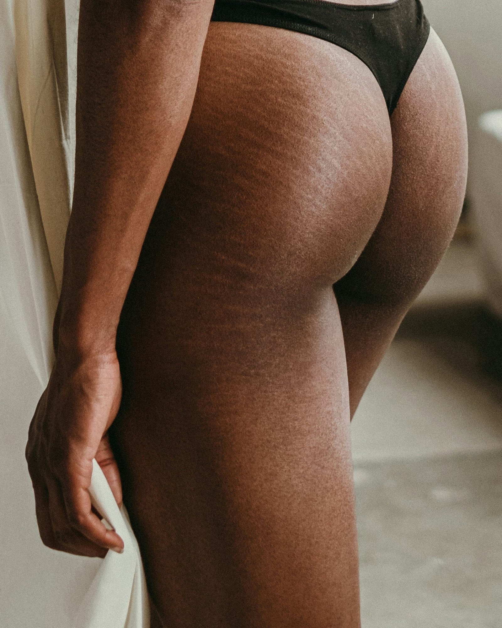 Natural Remedies to Reduce the Appearance of Stretch Marks
